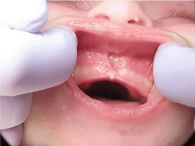 After lip tie release — restored lip mobility