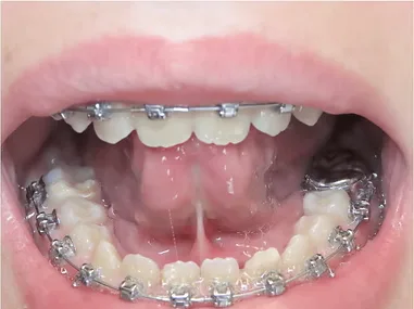 Before tongue tie release — restrictive frenulum visible beneath the lifted tongue
