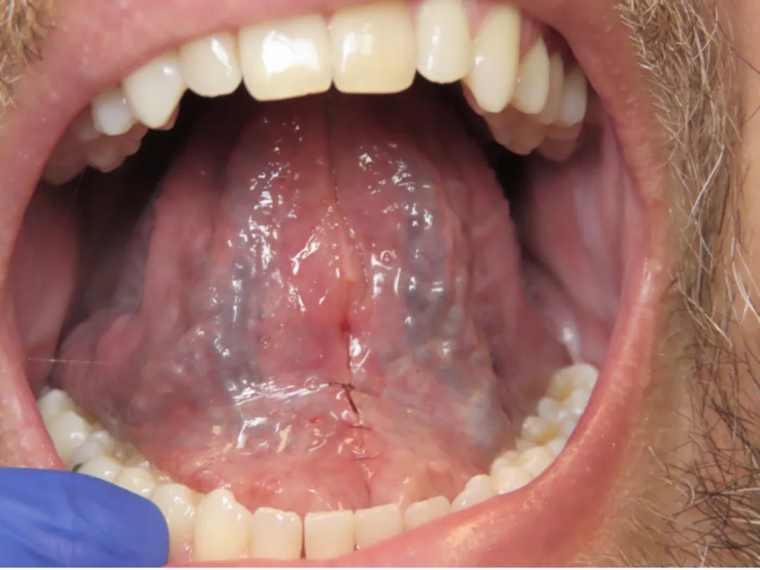 Adult tongue tie after frenectomy — sutures visible, restored mobility
