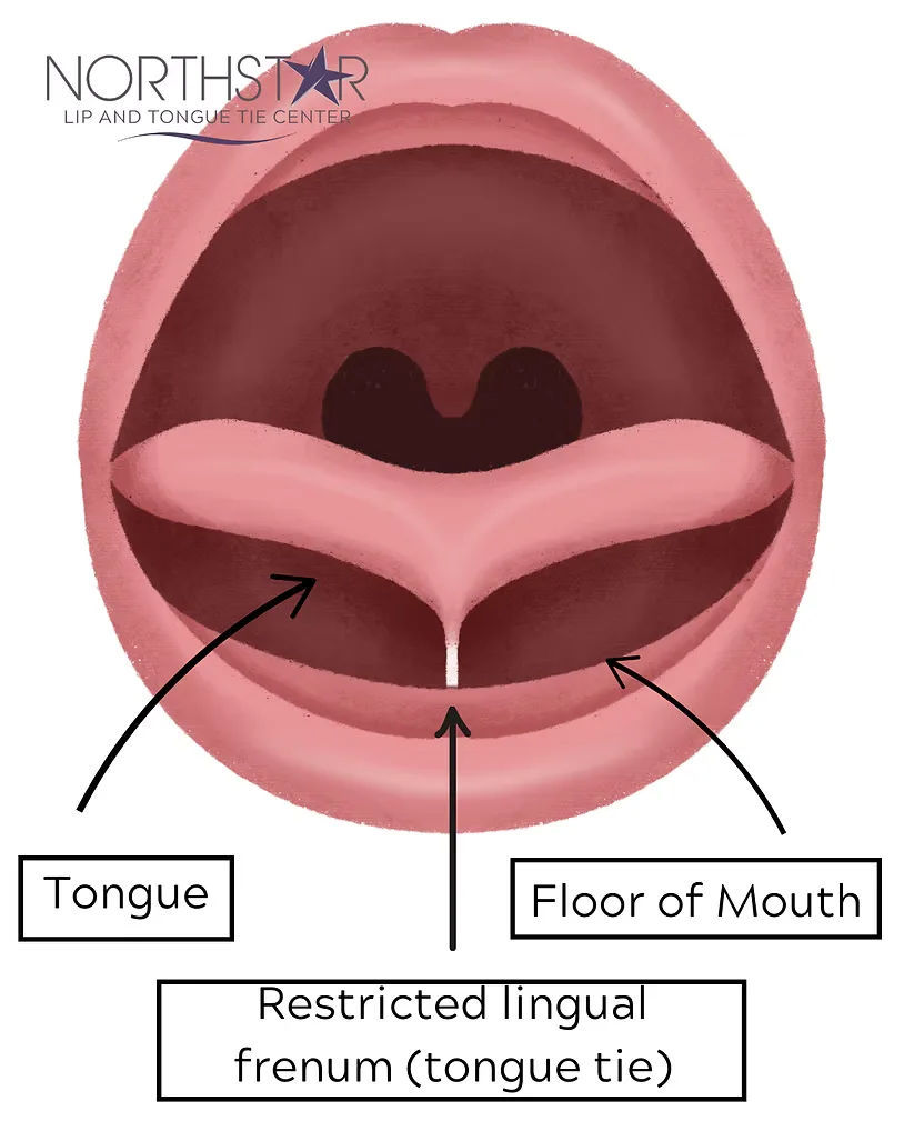 Annotated anatomy of an infant tongue tie — restricted lingual frenum tethering the tongue to the floor of the mouth