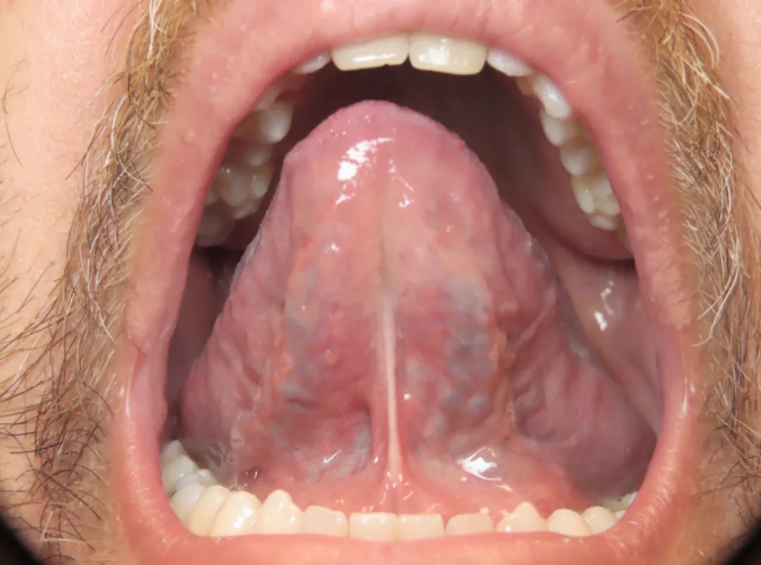 Adult tongue tie before frenectomy — restrictive frenulum visible beneath the lifted tongue