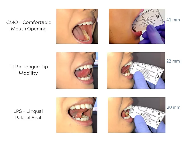 Three-step measurement: comfortable mouth opening, tongue tip mobility, and lingual palatal seal