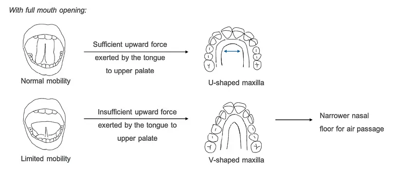 Diagram comparing normal tongue mobility producing a U-shaped maxilla against limited mobility producing a V-shaped maxilla