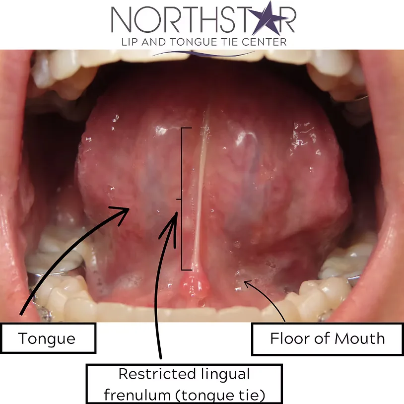 Annotated anatomy of an adult tongue tie — restricted lingual frenulum tethering the tongue to the floor of the mouth