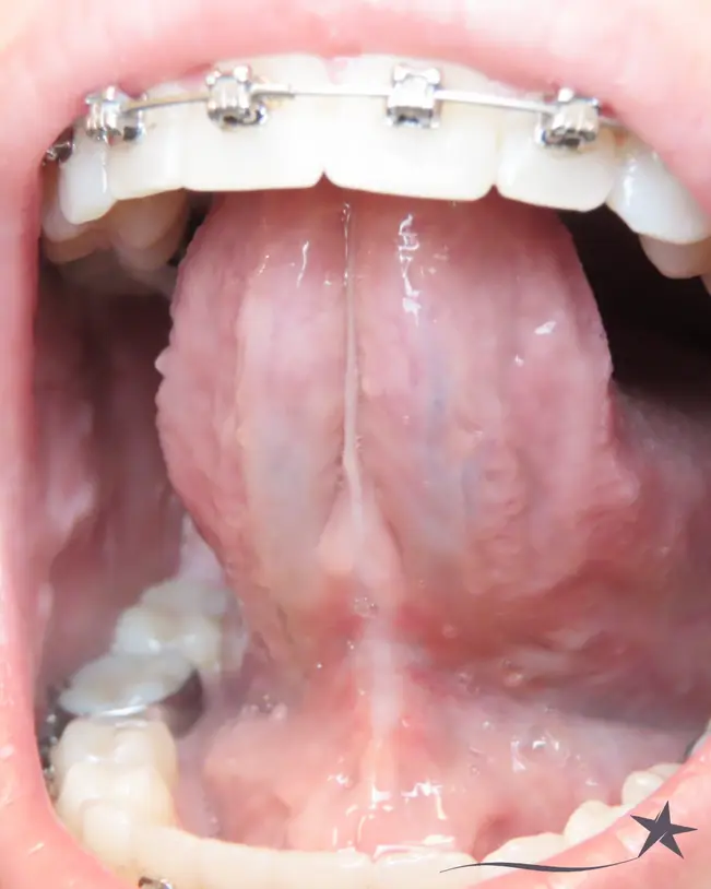 How Flexible Is Your Tongue? Measure Your Mobility to Check for a Tongue Tie