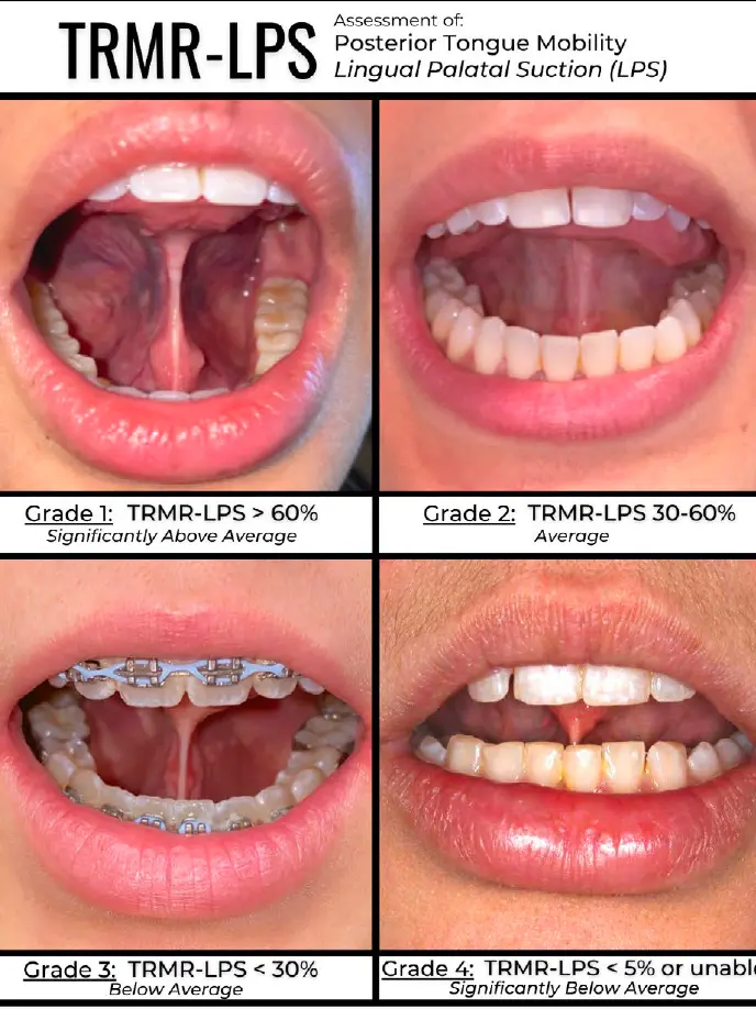 TRMR-LPS grading scale — four grades of posterior tongue mobility (lingual palatal suction)