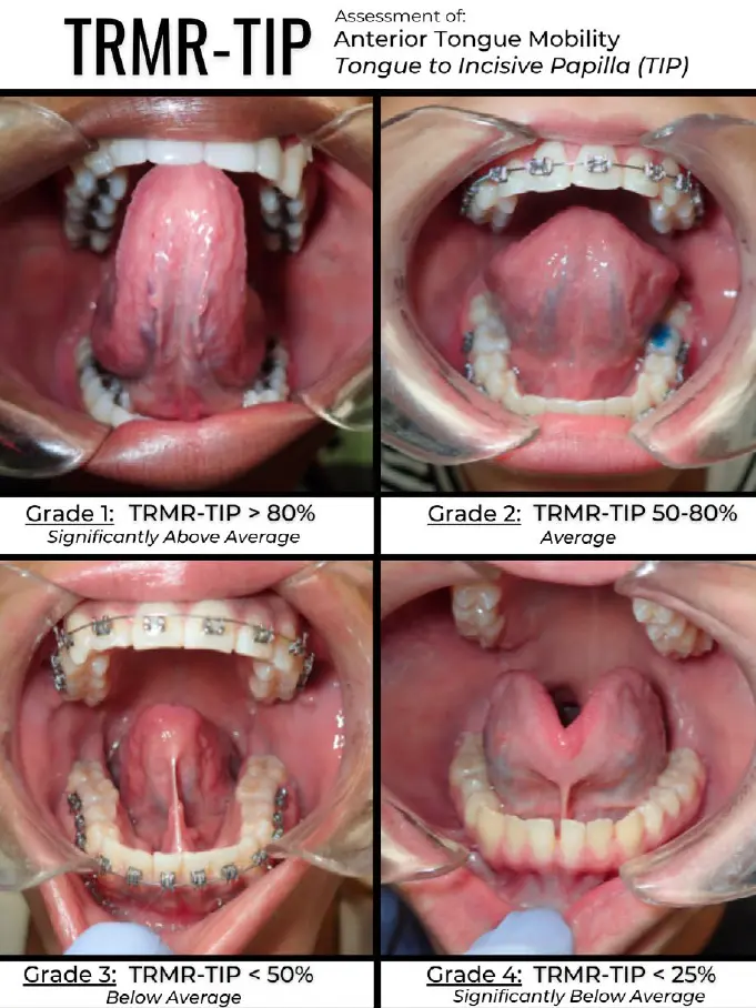 TRMR-TIP grading scale — four grades of anterior tongue mobility (tongue tip to incisive papilla)