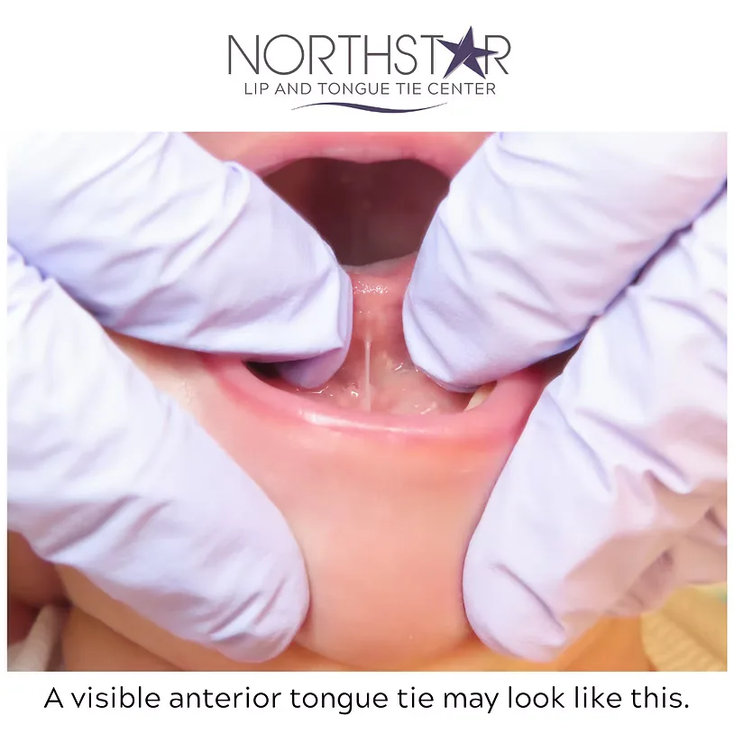 Clinical close-up of a visible anterior tongue tie in an infant