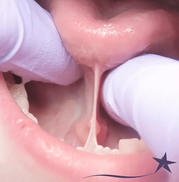 Clinical close-up of a tongue tie — restrictive frenulum visible beneath the lifted tongue